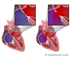 Atrial Septal Defects