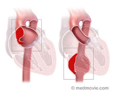 Aortic Aneurysm