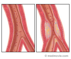 Coronary Artery Disease