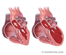 Dilated Cardiomyopathy