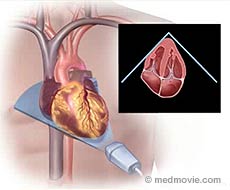 Heart Ultrasound