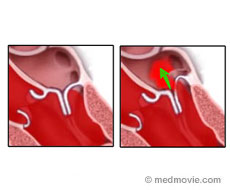 Mitral Valve Regurg