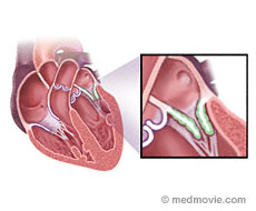 MItral Valve Stenosis