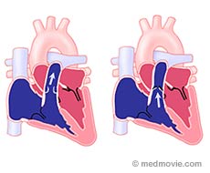 Pulmonary Stenosis